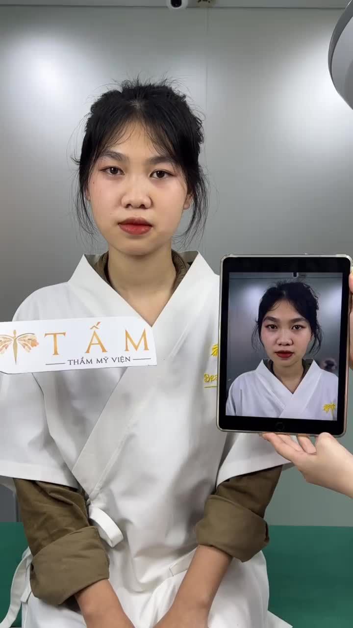 Bạn Hà sau thời gian tìm hiểu đã quyết định đến tư vấn và làm dịch vụ Filler má tại TMV Tấm. Phần má hóp của bạn đã được cải thiện hoàn toàn sau 30p làm dịch vụ.
