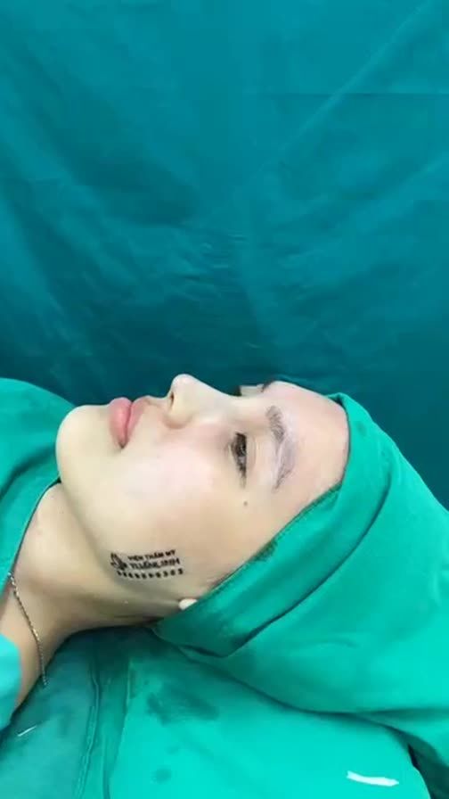 Case mũi bọc sụn vừa hoàn thành