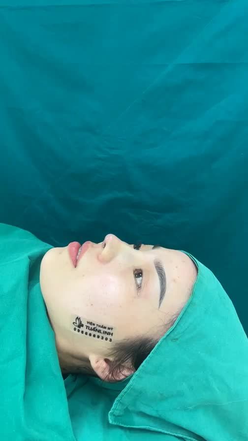 Case mũi cấu trúc vừa hoàn thành