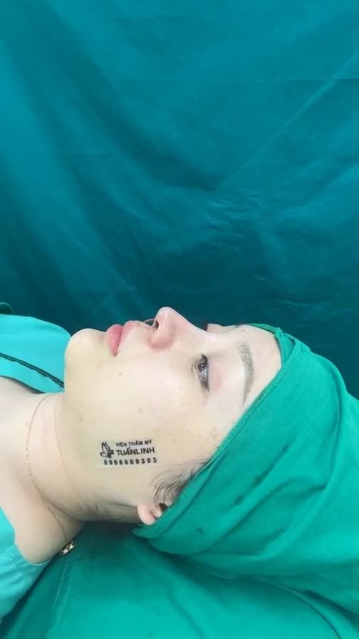 Case mũi cấu trúc sửa lại vừa hoàn thành