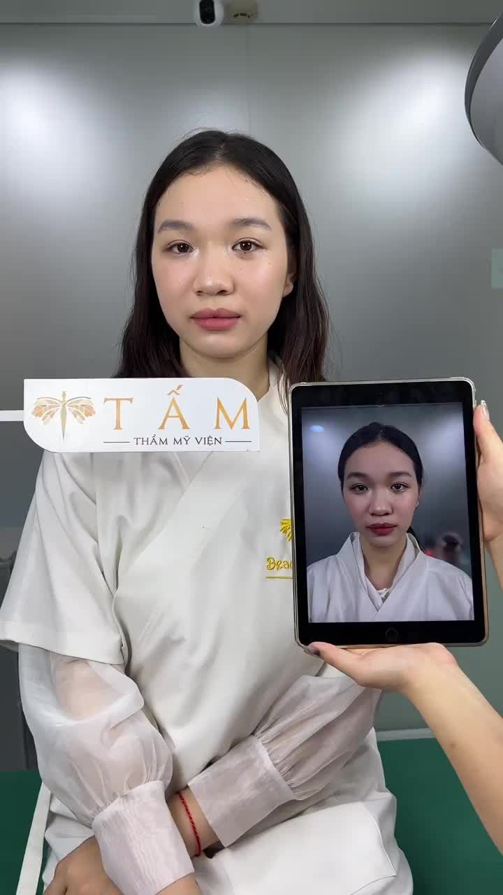 Cận cảnh ca cân chỉnh mặt với Filler má trọn gói của bạn Uyên.