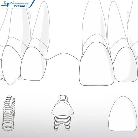 CÔNG NGHỆ PHỤC HÌNH RĂNG SỨ TRÊN IMPLANT DCT - GIẢI QUYẾT THÁCH THỨC VỀ THẨM MỸ VÀ GIẮT THỨC ĂN