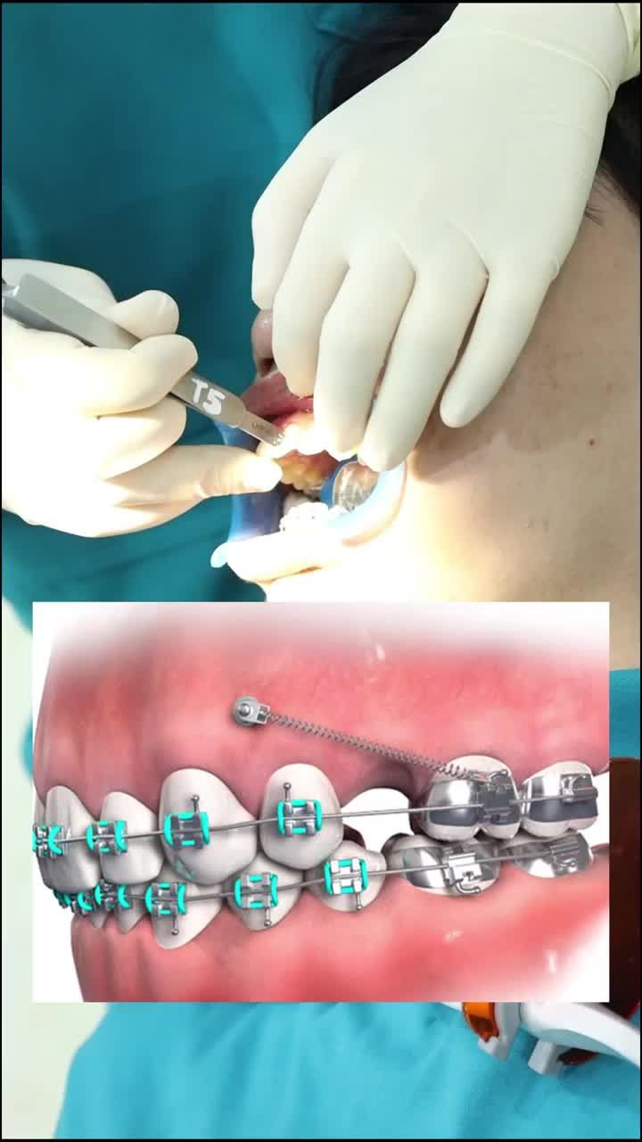 Có thể bạn chưa biết về minivis trong chỉnh nha?