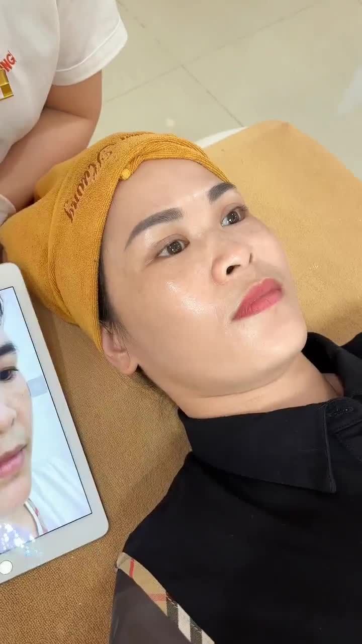 Chị Ngân với tình trạng da mỏng yếu, nám sạm lan rộng hơn do sử dụng retinol quá liều đã tin tưởng giao phó làn da cho bác sĩ tại VTM Xuân Hương.