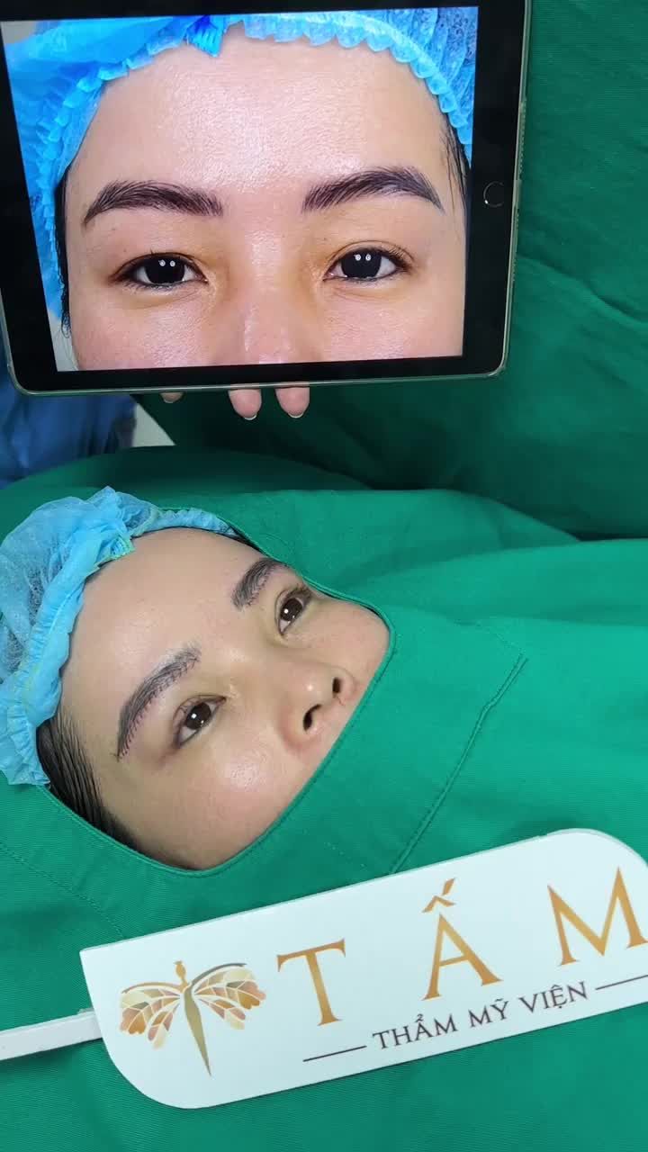 Ca Nâng cung chân mày tại phòng khám TMV Tấm!