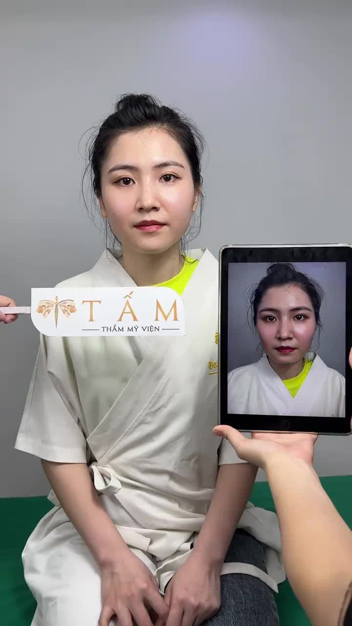 Ca Filler Má, Cằm tại phòng khám TMV Tấm.