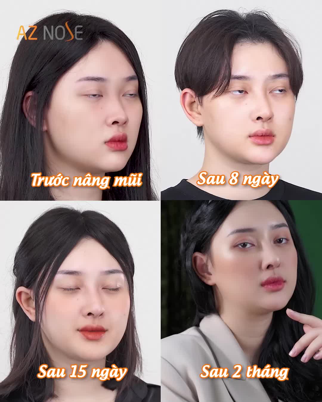 Đừng để ý mái tóc của ca sĩ Chu Thúy Quỳnh! Hãy để ý dáng mũi đã thay đổi gương mặt cô ấy như thế nào!