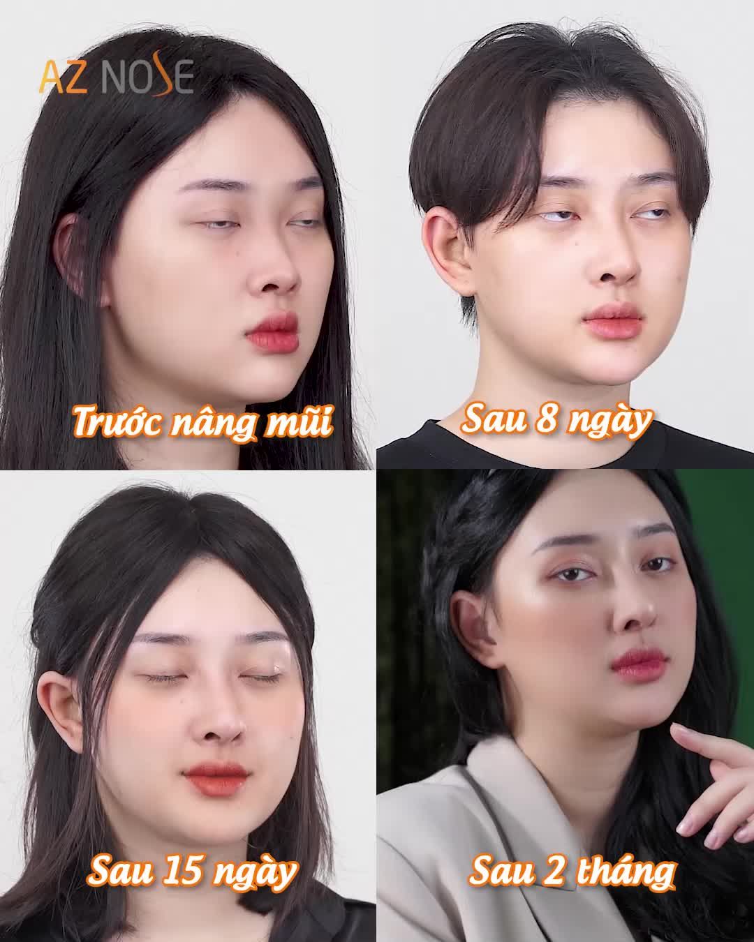 Đừng để ý mái tóc của ca sĩ Chu Thúy Quỳnh! Hãy để ý dáng mũi đã thay đổi gương mặt cô ấy như thế nào!