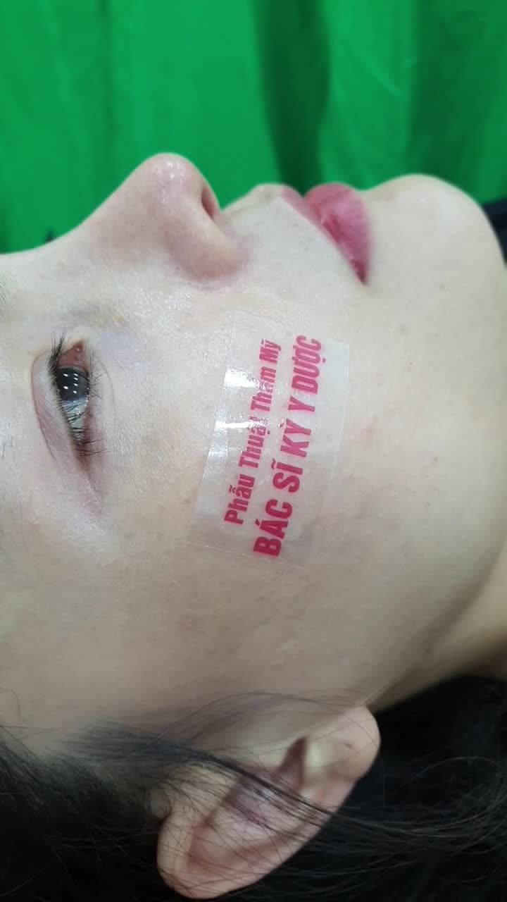 Tái khám Nâng Mũi ALINE Bán Cấu trúc Trúc Đa Lớp Sau 1 Năm