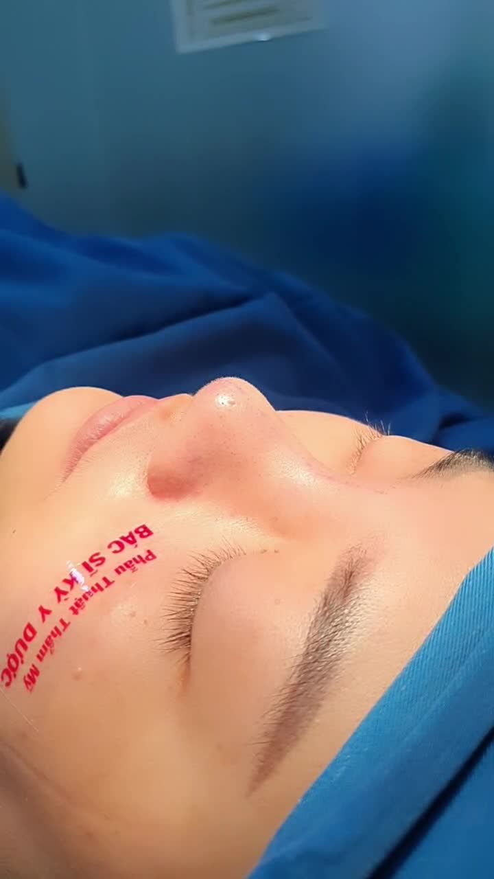Đã từng nâng mũi cách đây 5 năm nhưng dáng mũi lại không làm chị khách hài lòng.