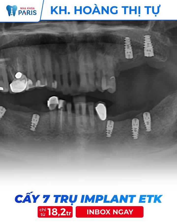 Trồng Implant trụ Pháp  Tặng 5.8 triệu