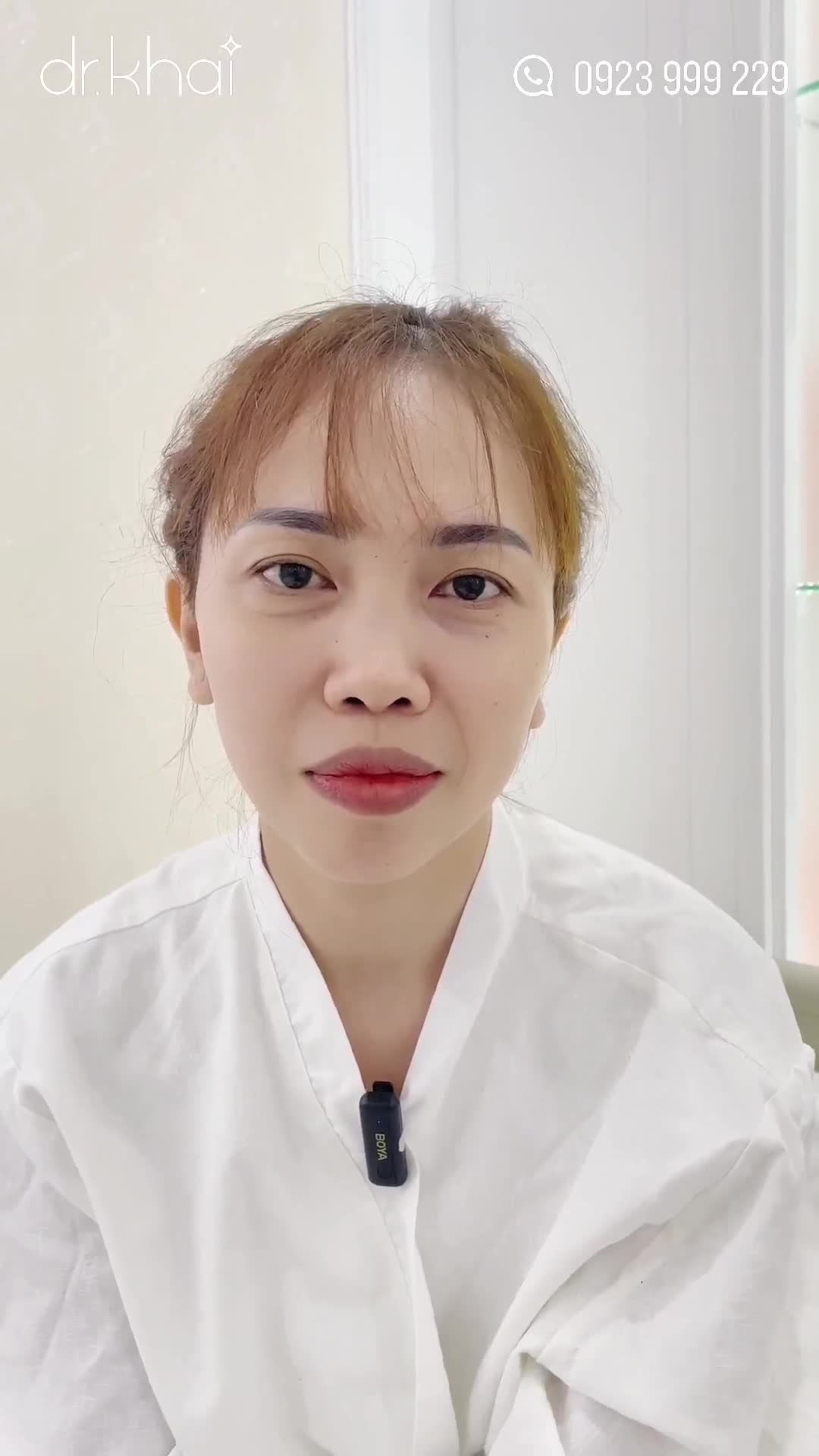 NÂNG MŨI CẤU TRÚC - KHÁCH HÀNG LẦN ĐẦU THẨM MỸ NHƯNG HOÀN TOÀN TIN TƯỞNG VÀO DR KHẢI