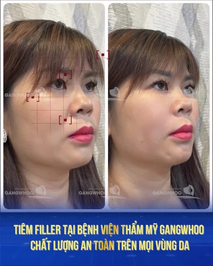 Chị Bích Liên khách hàng Việt Kiều tại Bệnh viện Thẩm mỹ Gangwhoo tan trang nhan sắc “sương sương” với combo Filler Má - Cằm mà kết quả hoàn hảo không tưởng!