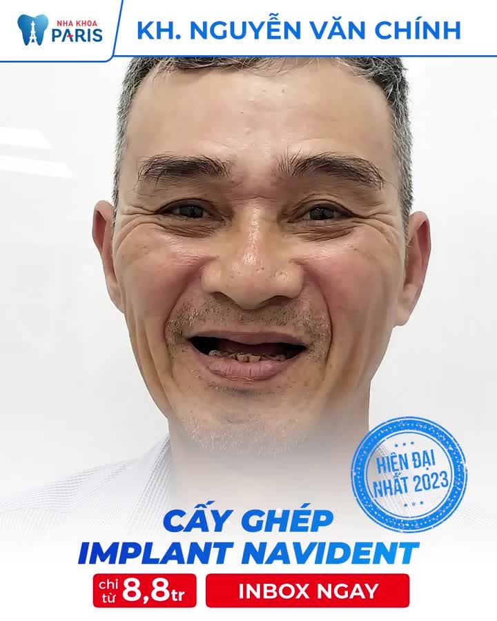 Chú Chính cấy Implant bằng Robot định vị Navident có gì khác biệt?