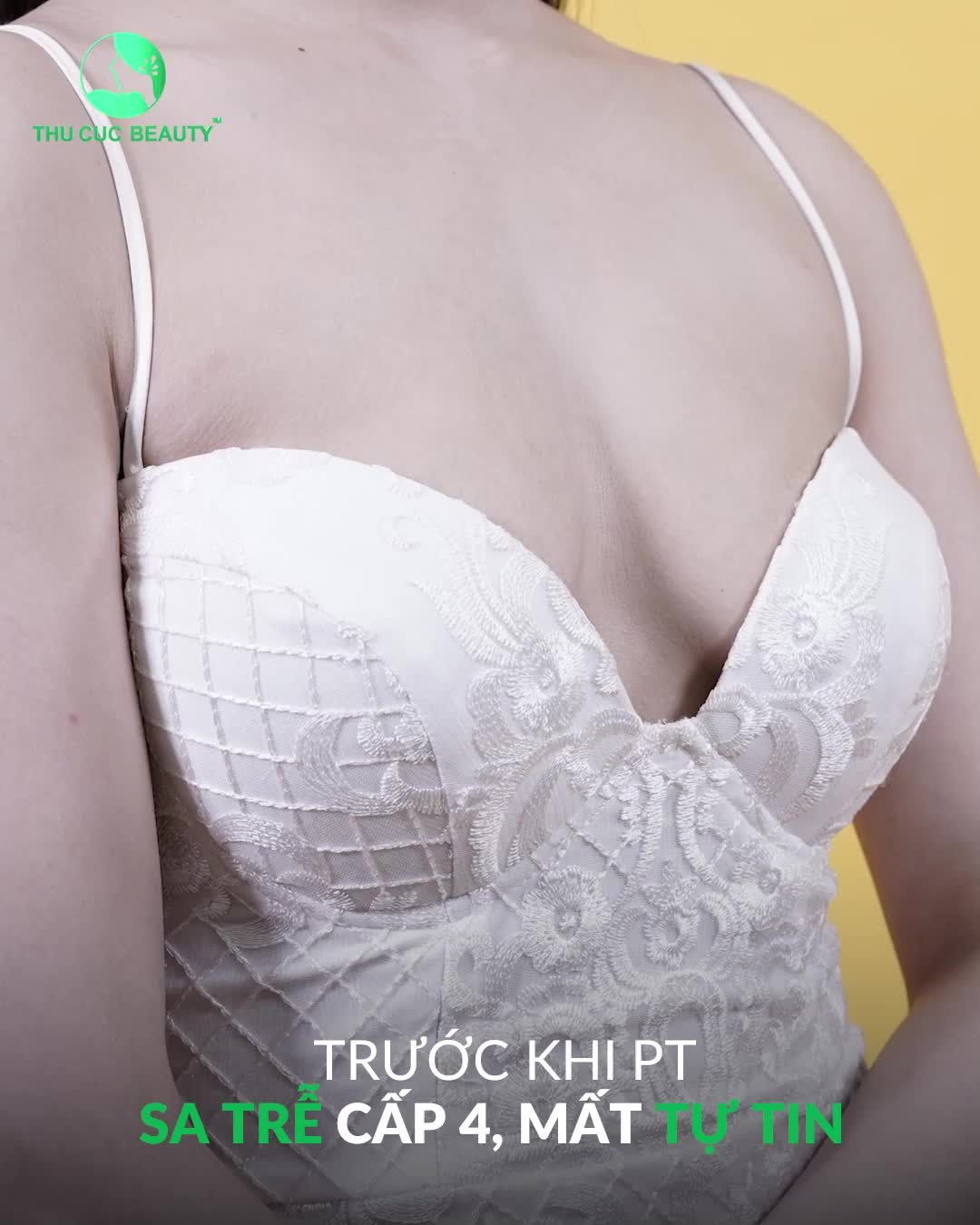 Sa trễ cấp 4 thay đổi ngỡ ngàng sau Nâng ngực TC Inbox ngay nhận ƯU ĐÃI SHOCK đón ĐẠI LỄ