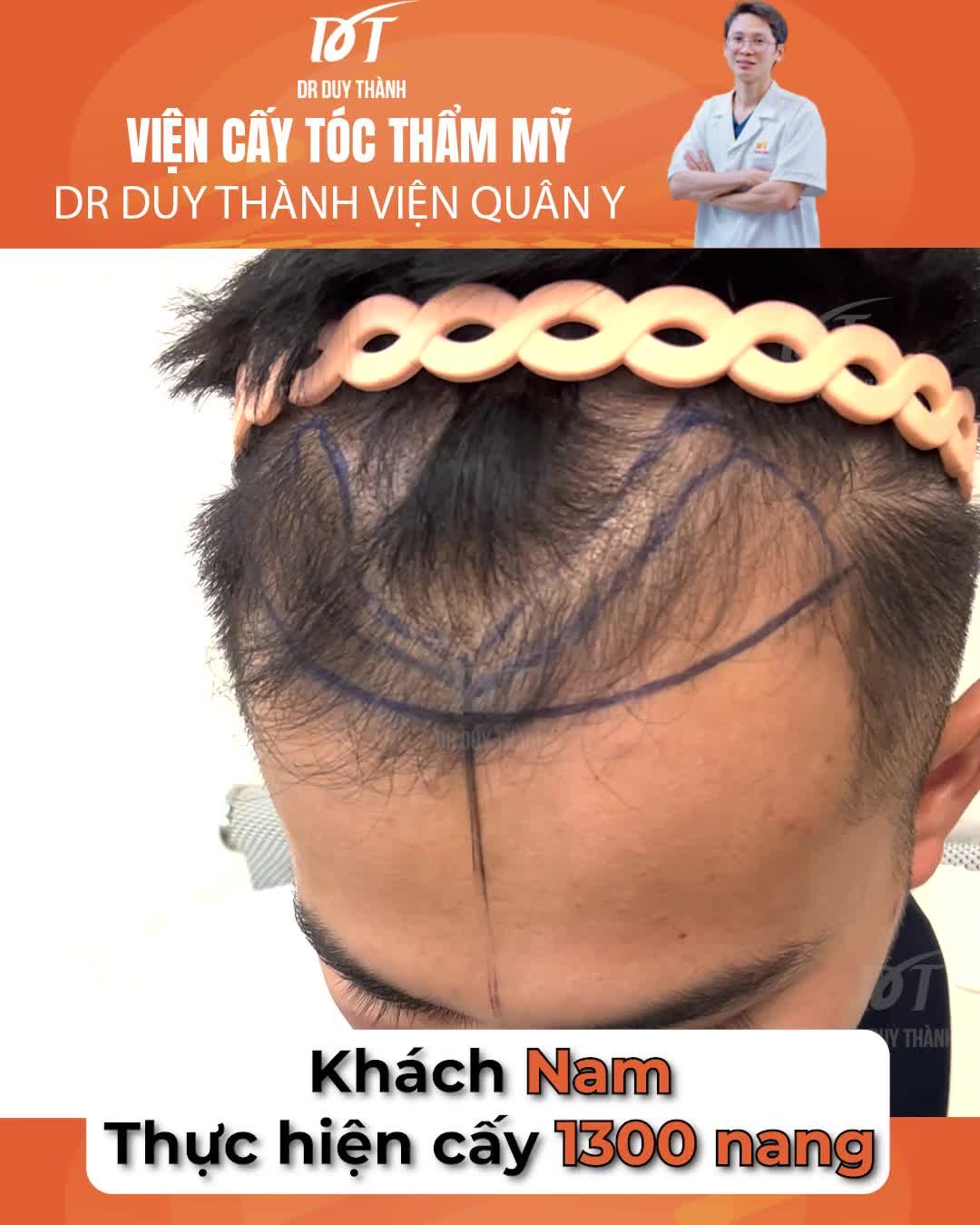 Hạ đường chân tóc bằng cấy tóc DHI 1300 nang