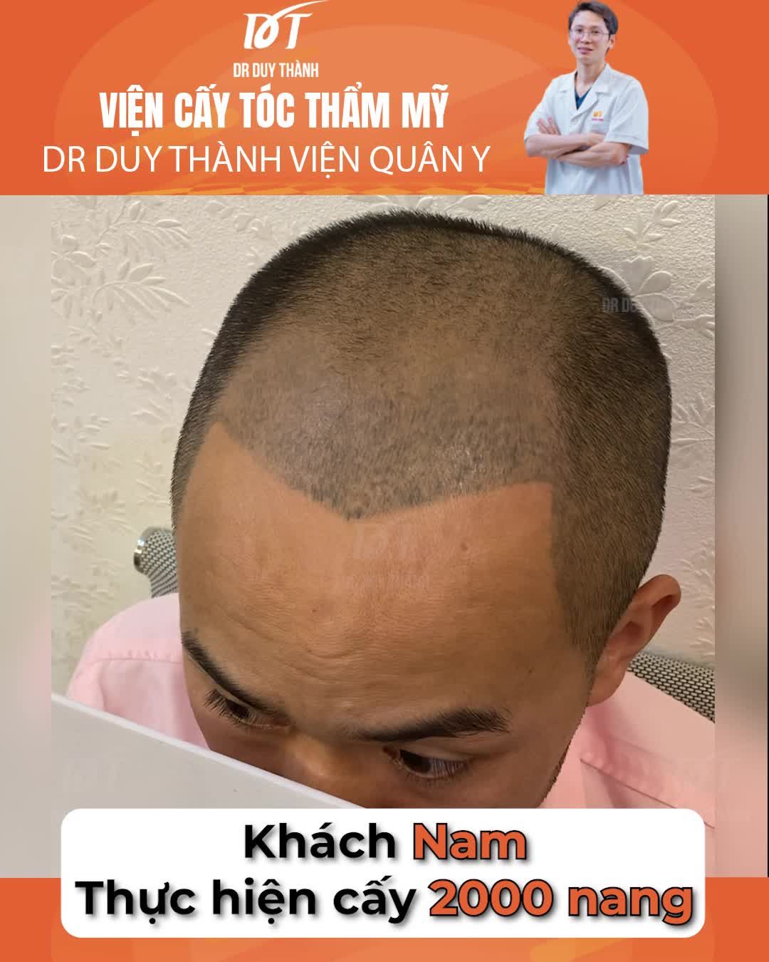 Cấy 2000 nang tóc chữa hói cho giáo viên thanh nhạc đã từng xăm chân tóc