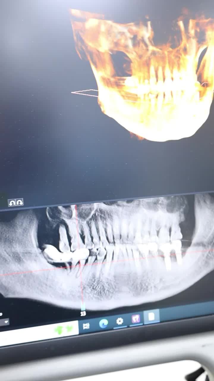 Những yếu tố ảnh hưởng tới chi phí cấy Implant?