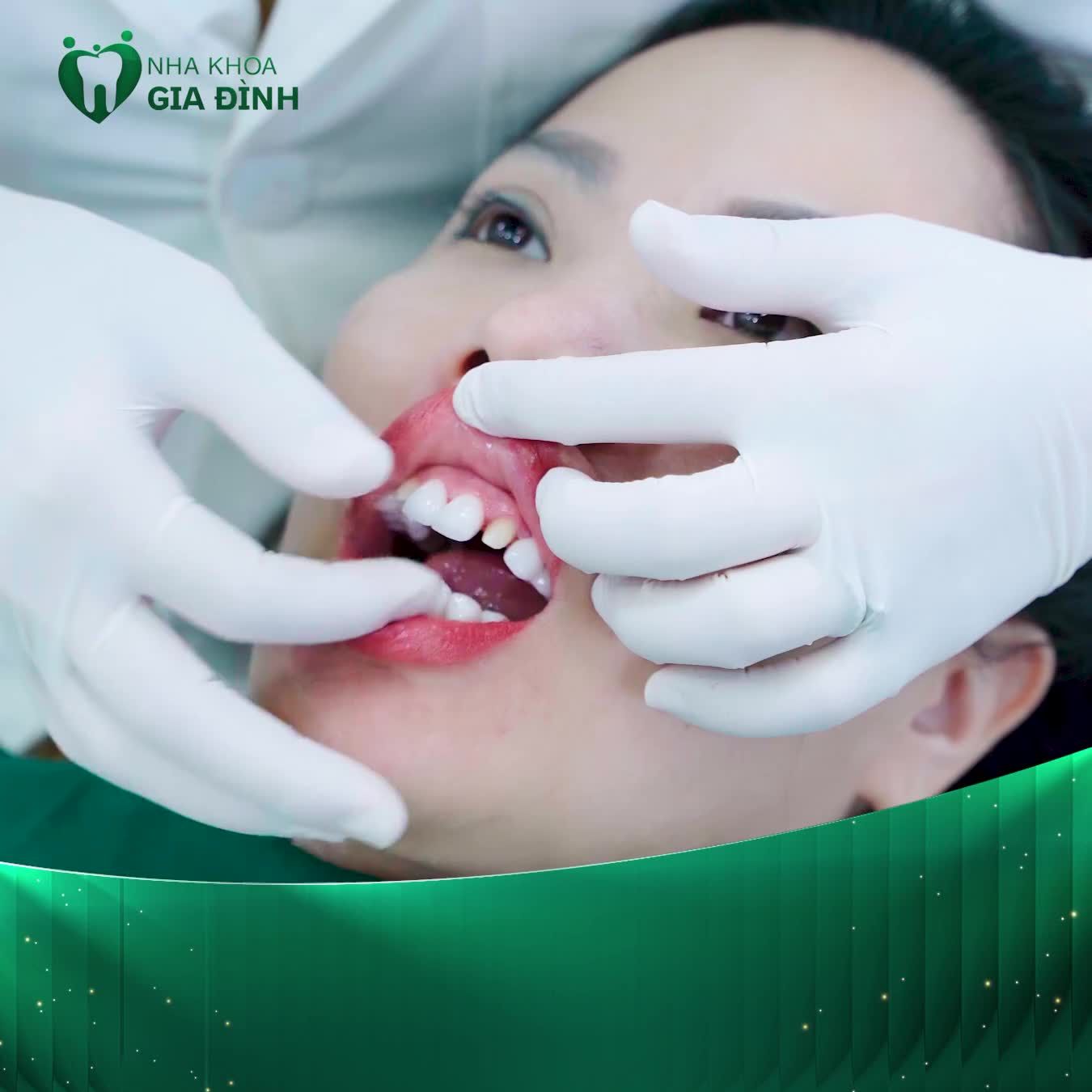 ĐỀN GẤP 100 LẦN NẾU PHÁT HIỆN LÀ RĂNG SỨ KÉM CHẤT LƯỢNG
