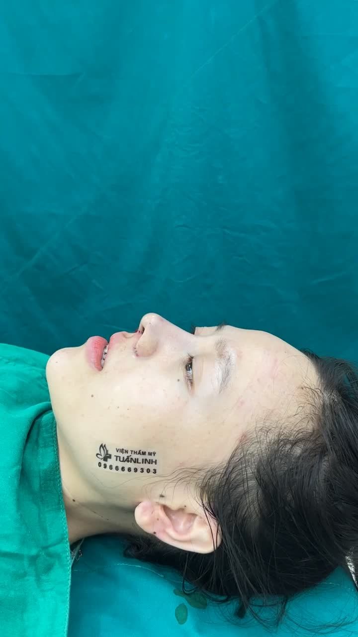 Case mũi cấu trúc + cuộn cánh vừa hoàn thành