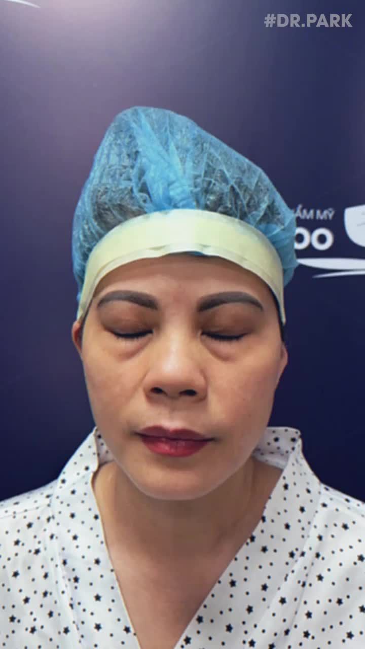 CẮT MÍ EYELID MANG LẠI CHO BẠN ĐIỀU GÌ?