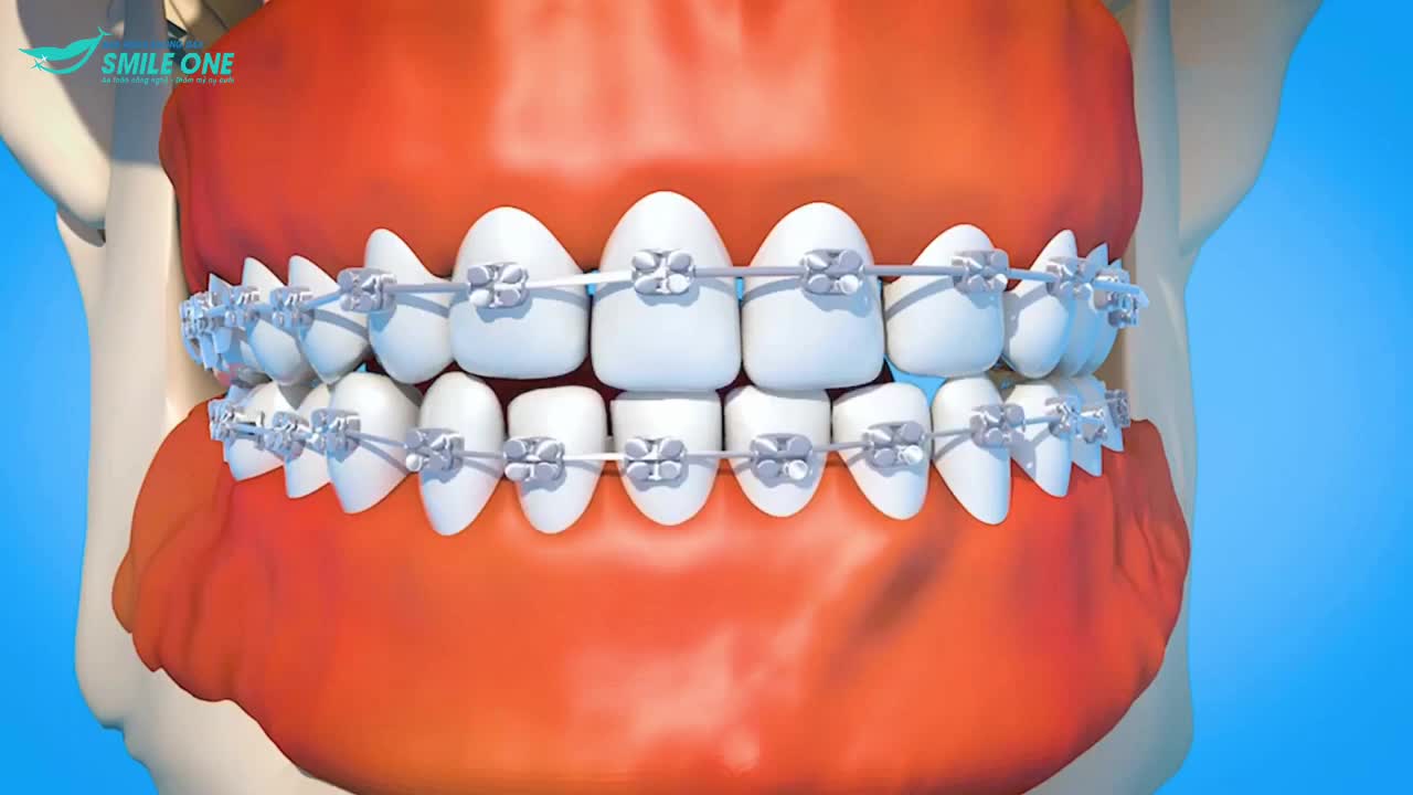 Niềng răng mắc cài hoạt động như thế nào?