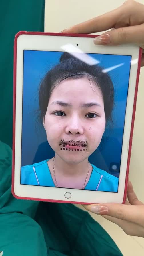 Case mũi nâng cấp sau 7 năm dùng phuơng pháp bọc sụn