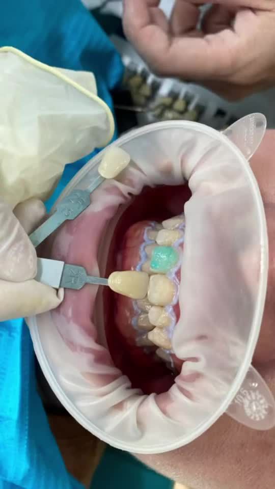 RĂNG TRẮNG BẬT TONE NÓI KHÔNG VỚI Ê BUỐT