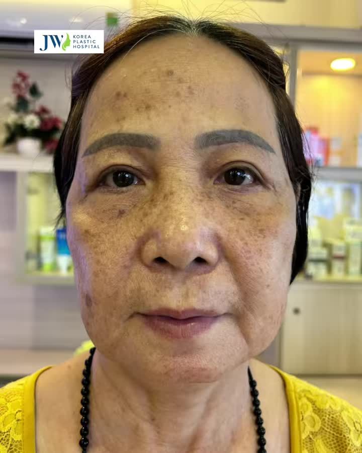 ĐIỀU TRỊ HẾT NÁM, ĐỐM NÂU LÂU NĂM CHO QUÝ BÀ U70
