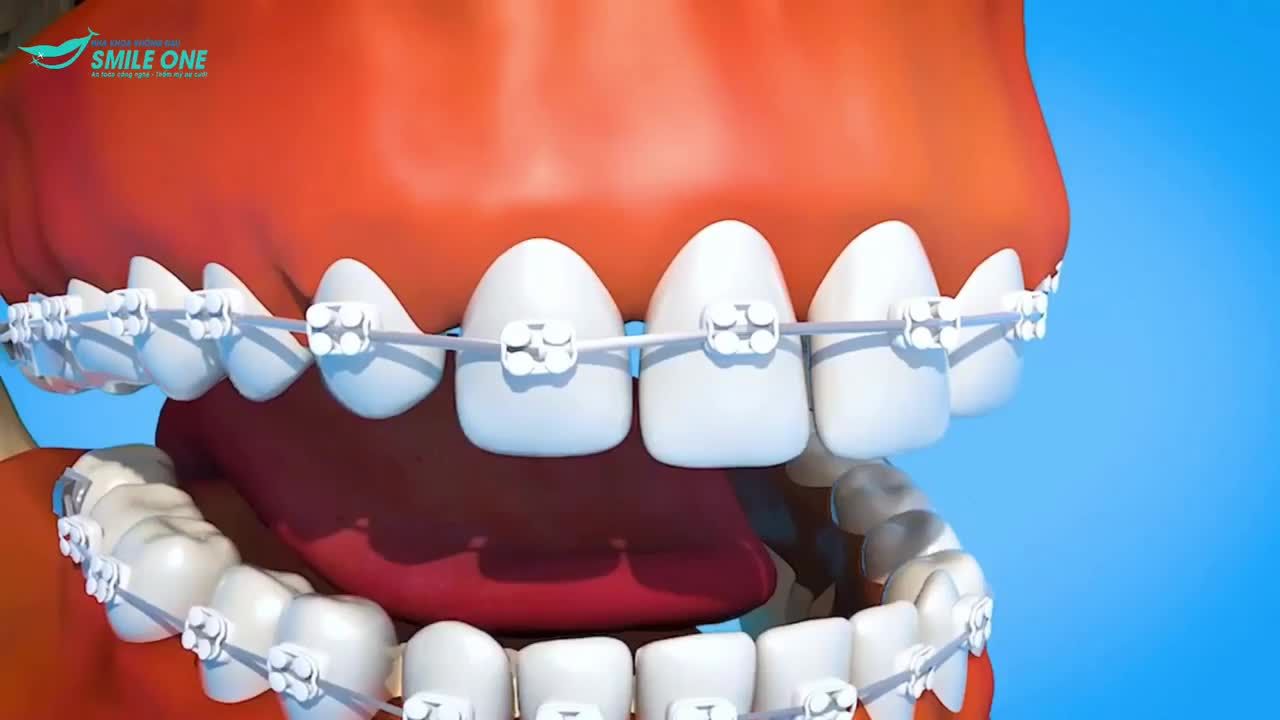 Tác dụng của minivis trong niềng răng!