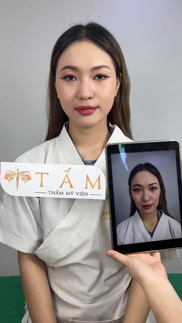 Ca Filler má, cằm tại phòng khám TMV Tấm.