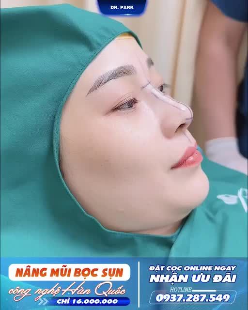 NÂNG MŨI BỌC SỤN - MŨI ĐẸP AN TOÀN