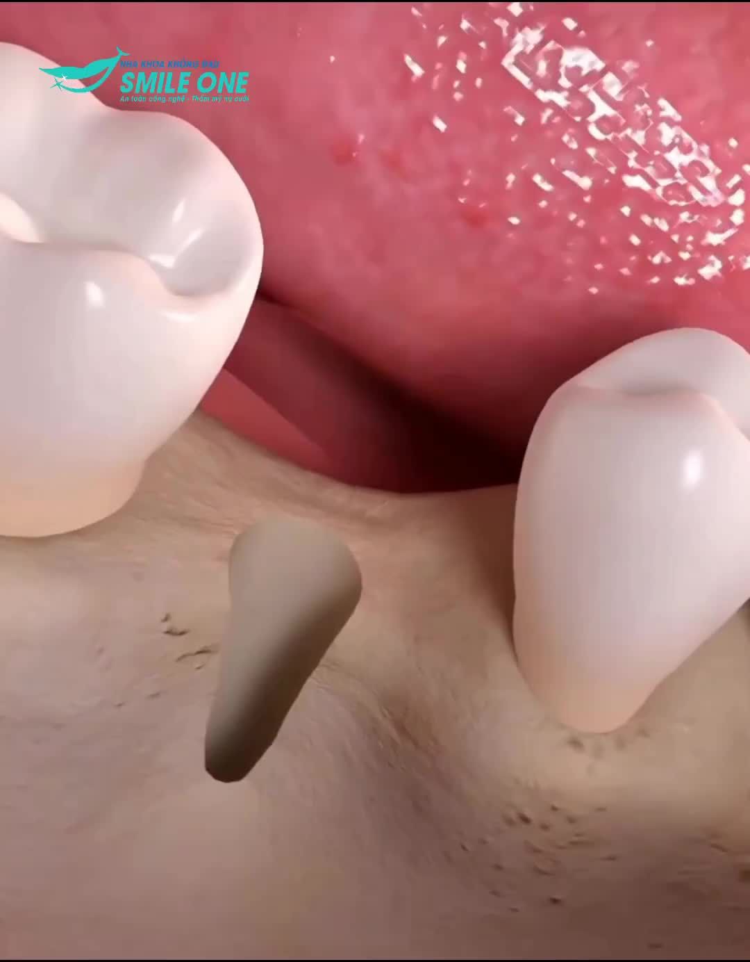 Mô phỏng quá trình trồng răng implant