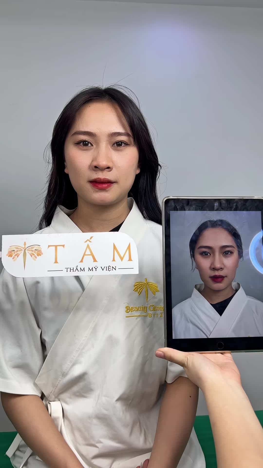 Ca filler má tại phòng khám Thẩm mỹ viện Tấm.
