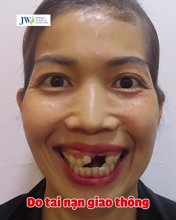 PHẪU THUẬT HÀM HÔ giúp nữ doanh nhân Bình Dương thoát ám ảnh CƯỜI HỞ LỢI, TÉ GÃY RĂNG
