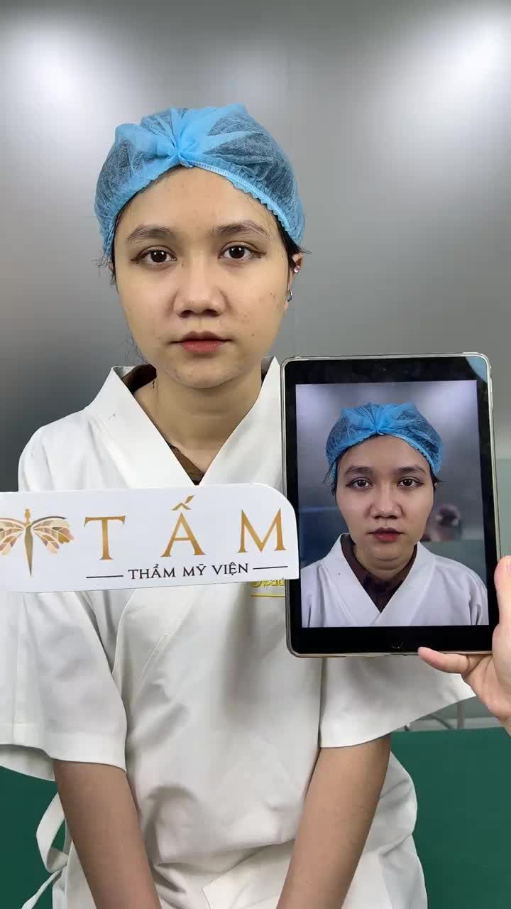Ca cân chỉnh thái dương và má tại TMV Tấm