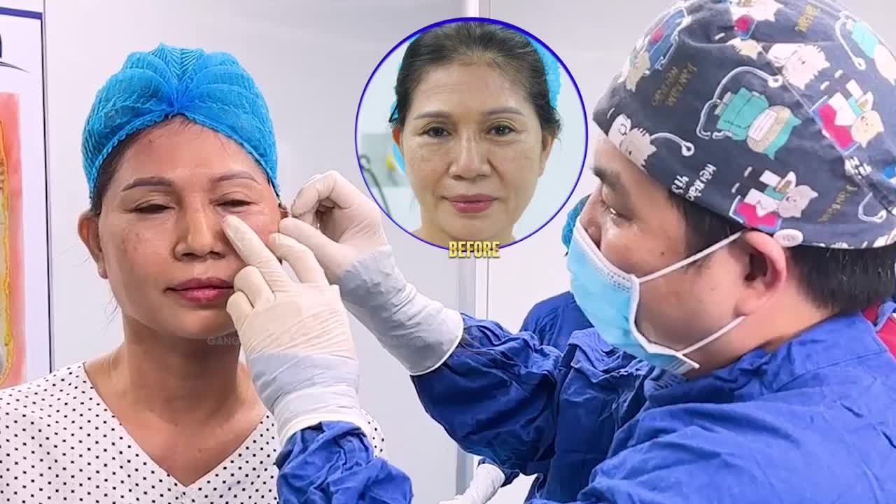 DEEP SMAS LASER 5.0 - GIẢI PHÁP TRẺ HÓA DA KHÔNG PHẪU THUẬT