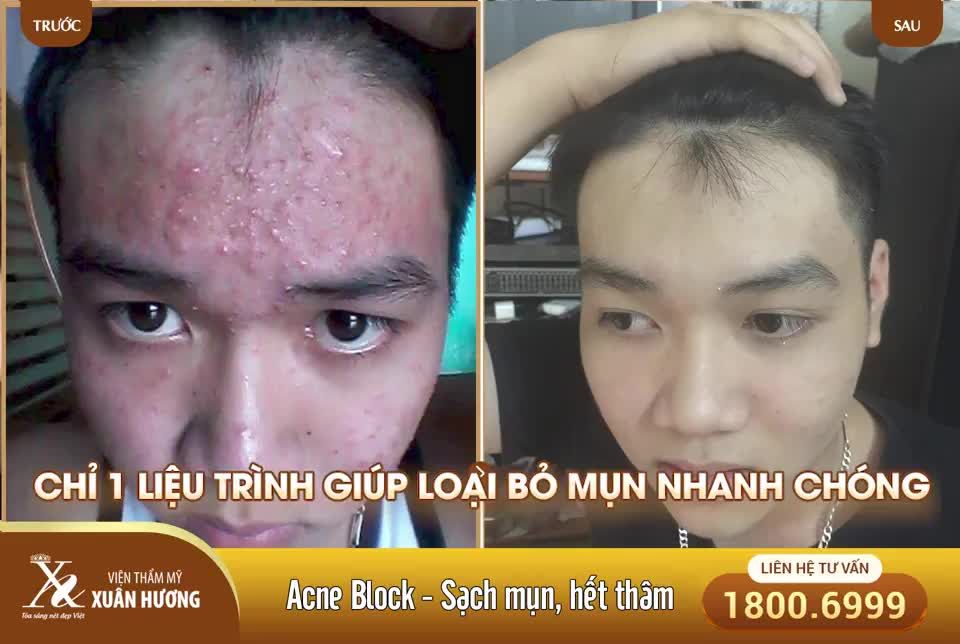 Mụn nếu không được điều trị đúng cách, kịp thời tình trạng mụn sẽ tăng lên ,mụn để lâu ngày sẽ trở thành sẹo rỗ…