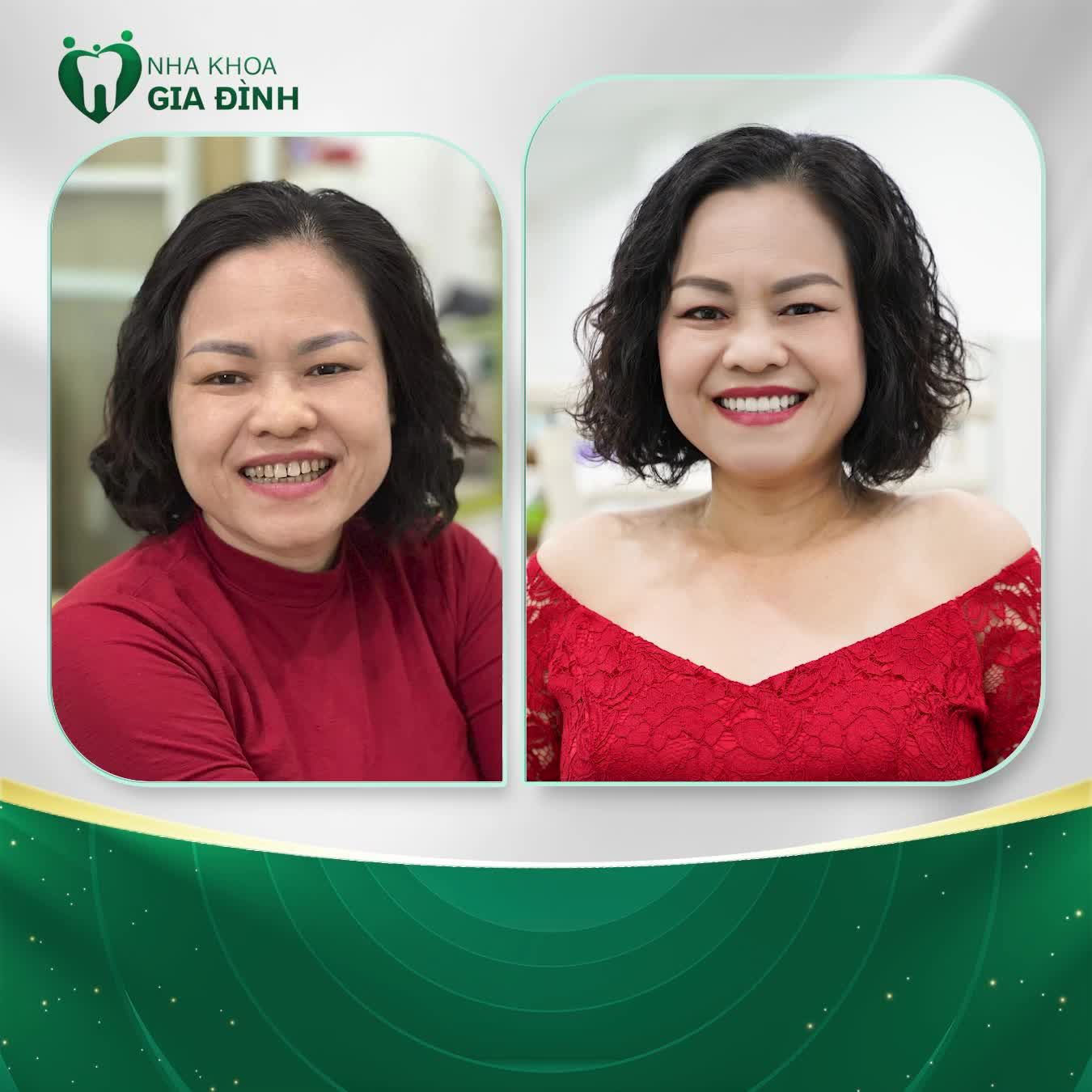 SỰ THAY ĐỔI CỦA KHÁCH HÀNG LÀ MINH CHỨNG RÕ NÉT CHO CHẤT LƯỢNG DỊCH VỤ TẠI NHA KHOA GIA ĐÌNH