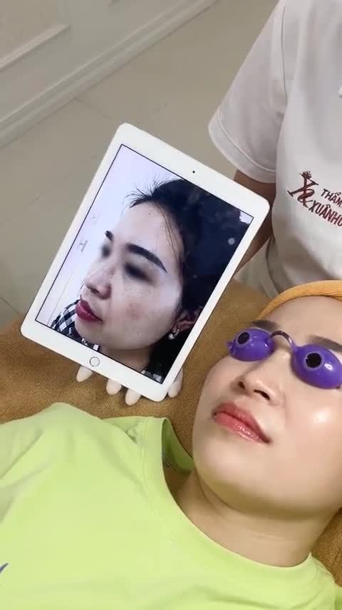 Melas Picosure đỉnh cao trong điều trị sắc tố