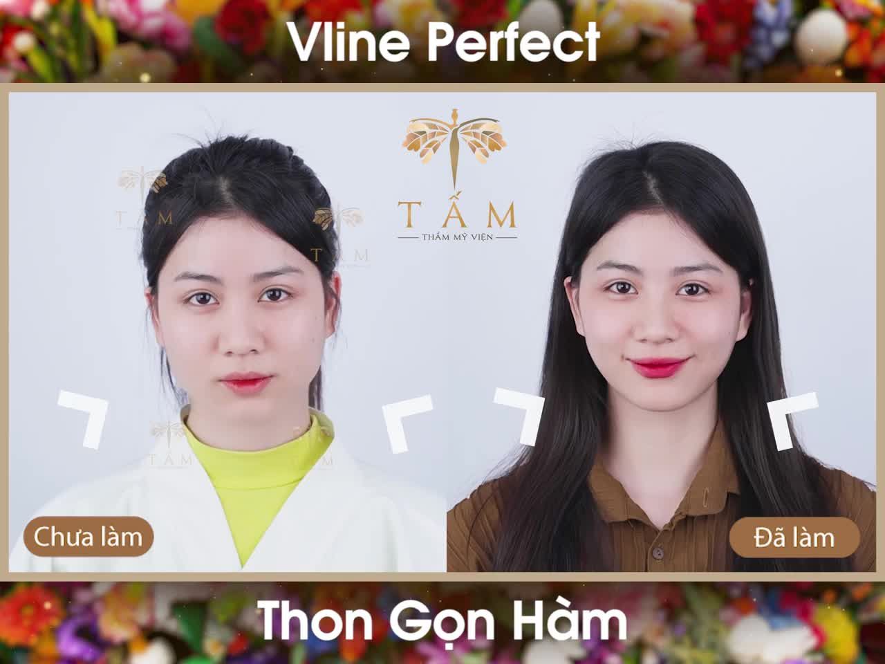 Vline Perfect gọn hàm - phương pháp nhanh chóng giúp cải thiện tình trạng mặt vuông to