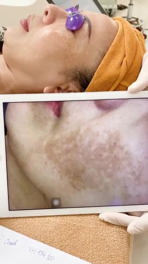 Da căng bóng, khỏe đẹp sau 1 lần điều trị nám kết hợp đưa dưỡng chất Meso