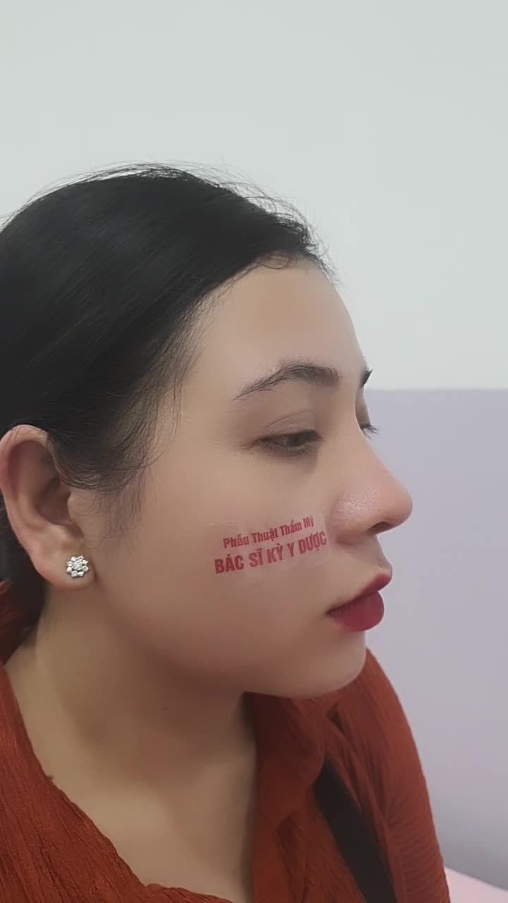 Hôm nay trung tâm đón tiếp bạn khách tái khám sau 1 tháng Nâng Mũi ALINE Bán Cấu Trúc 2 lớp.