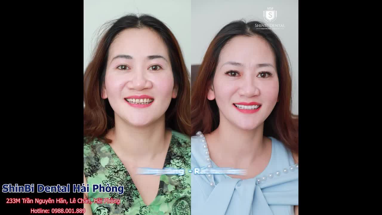 Hải Phòng là không lòng vòng: Không cần phải lăn tăn khi làm răng tại Shinbi!