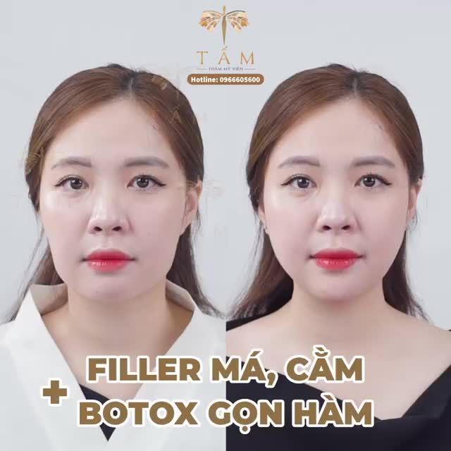 Có người nói gặp đúng người là lúc thanh xuân đẹp nhất. Còn Thu Hằng chia sẻ lúc thanh xuân tự tin nhất của cô ấy là gặp được combo Filler má, cằm và Botox gọn hàm bên Tấm