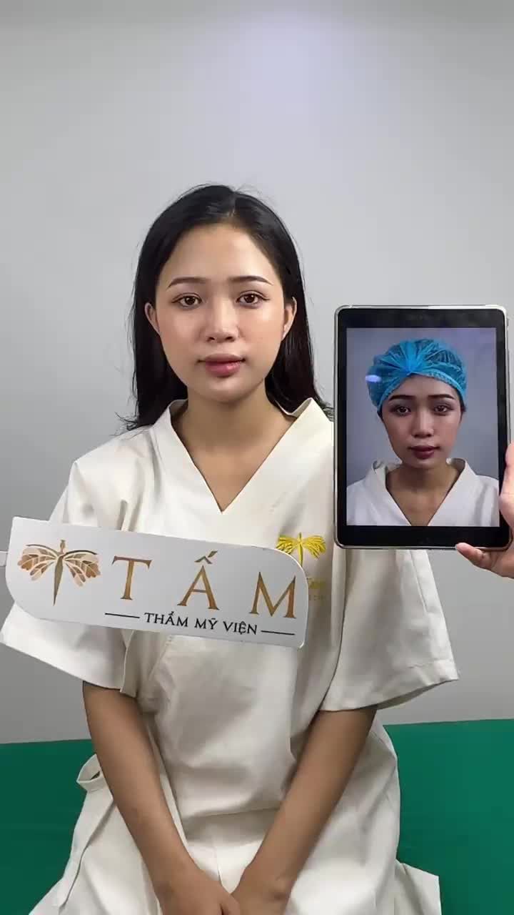 Ca filler má, cằm tại phòng khám TMV Tấm.