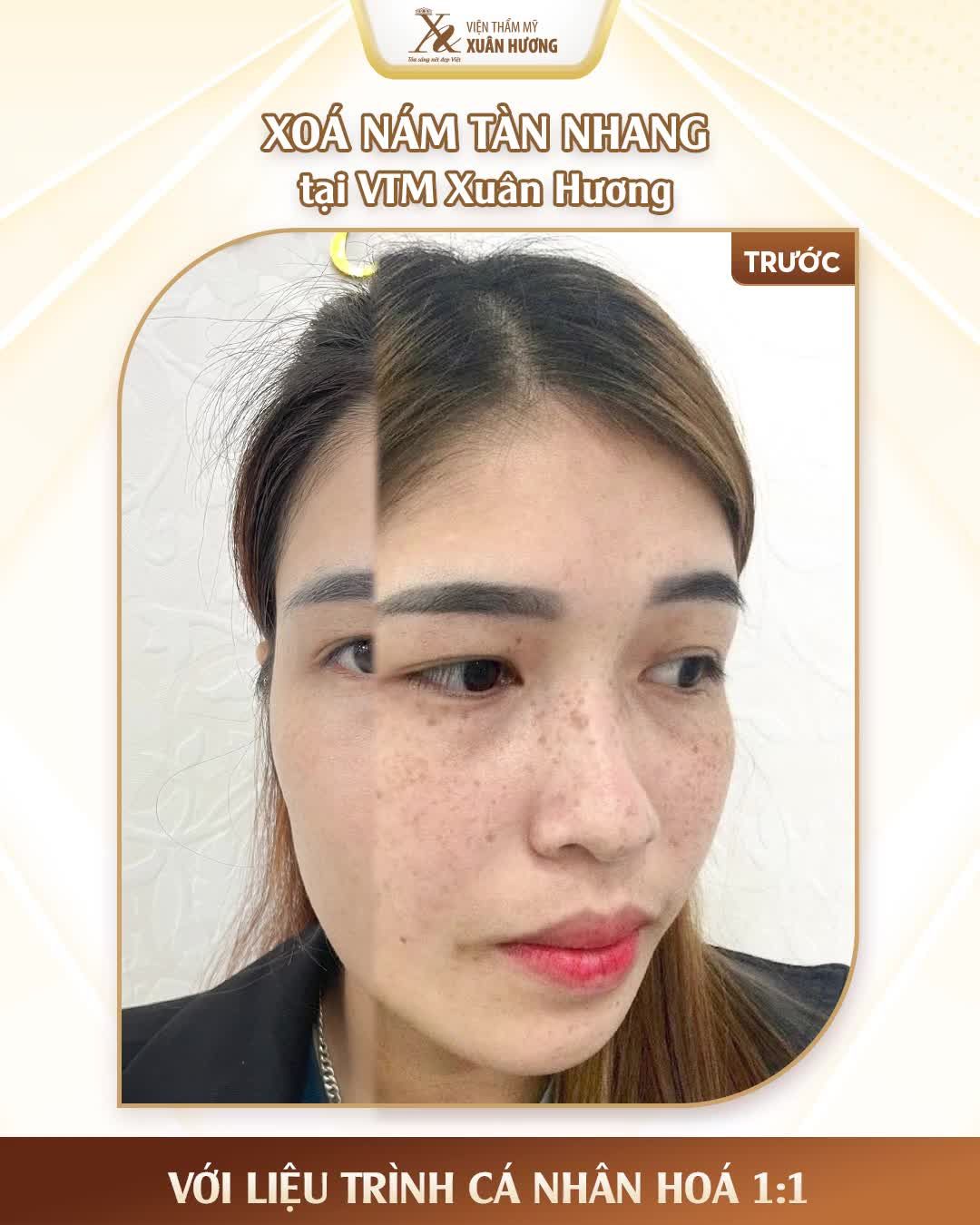 Đầu tư kịp thời nay đã "thu được quả ngọt", chị khách hàng đã bắt đầu liệu trình trị nám từ sau Tết, kiên trì theo phác đồ của bác sĩ và hiện tại đã xóa đến 95% nám tàn nhang trên mặt.