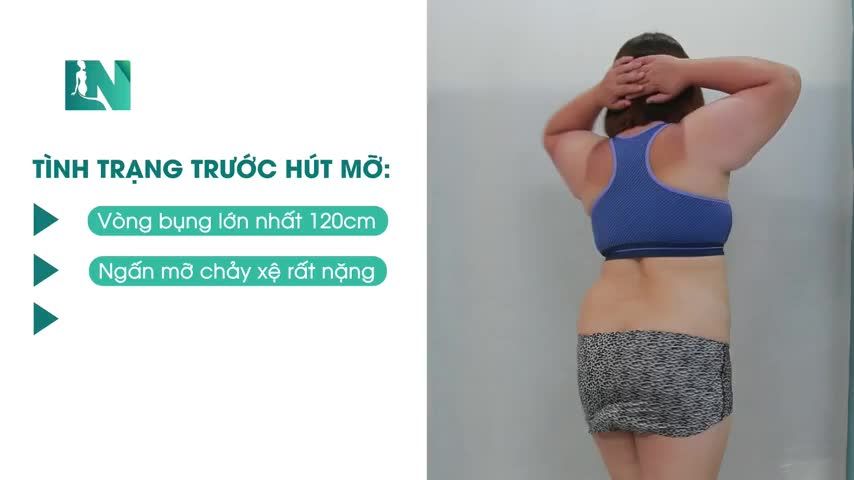 Cũng từng đắn đo, cũng từng lo lắng về sự an toàn khi lựa chọn hút mỡ.
