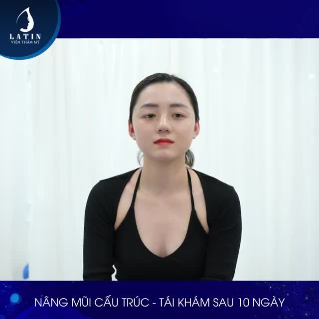 HÀNH TRÌNH NÂNG MŨI - TÌM LẠI TỰ TIN cho em gái đến từ Cần Thơ