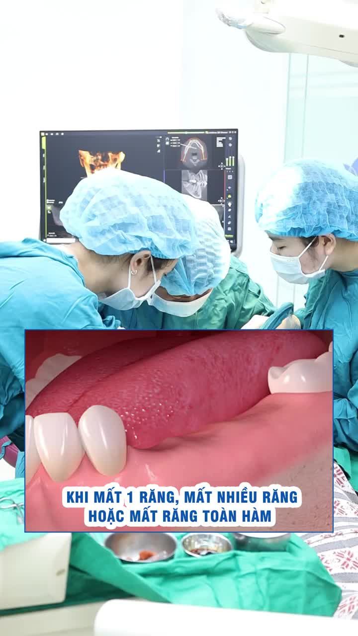 Thời gian chờ làm phục hình trên Implant mất bao lâu?